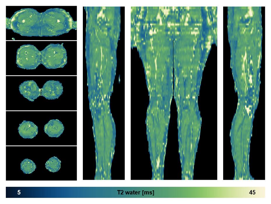 The water only T2 relaxation time of the lower extremity obtained from multi echo spin echo t2 mapping with EPG based reconstruction.